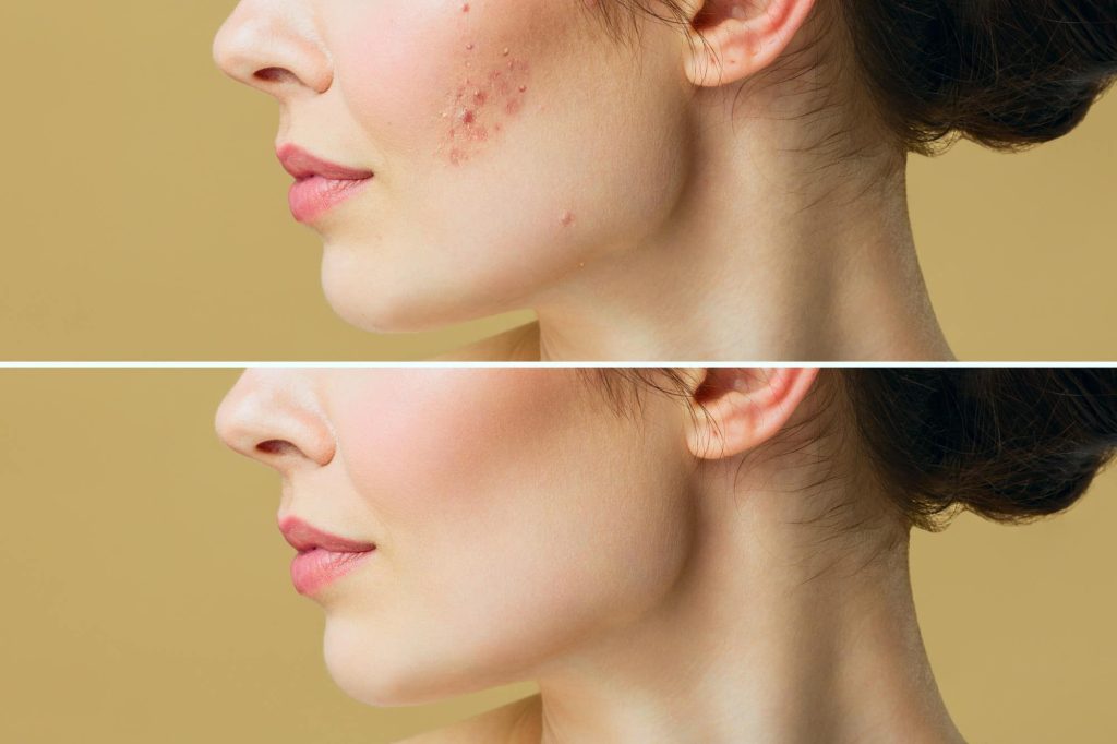 acne scar removal treatment malaysia
