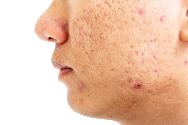 acne scar removal treatment malaysia