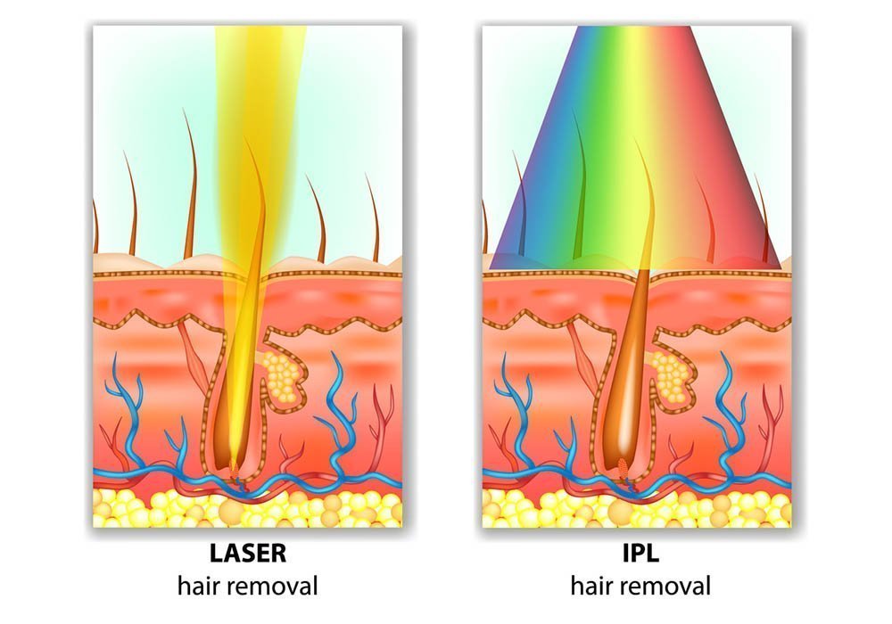 laser hair removal service
