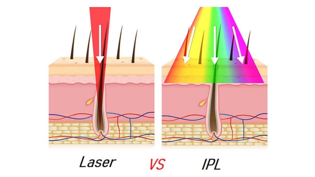 laser hair removal service
