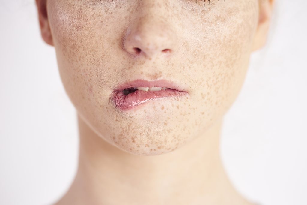 laser treatment for pigmentation