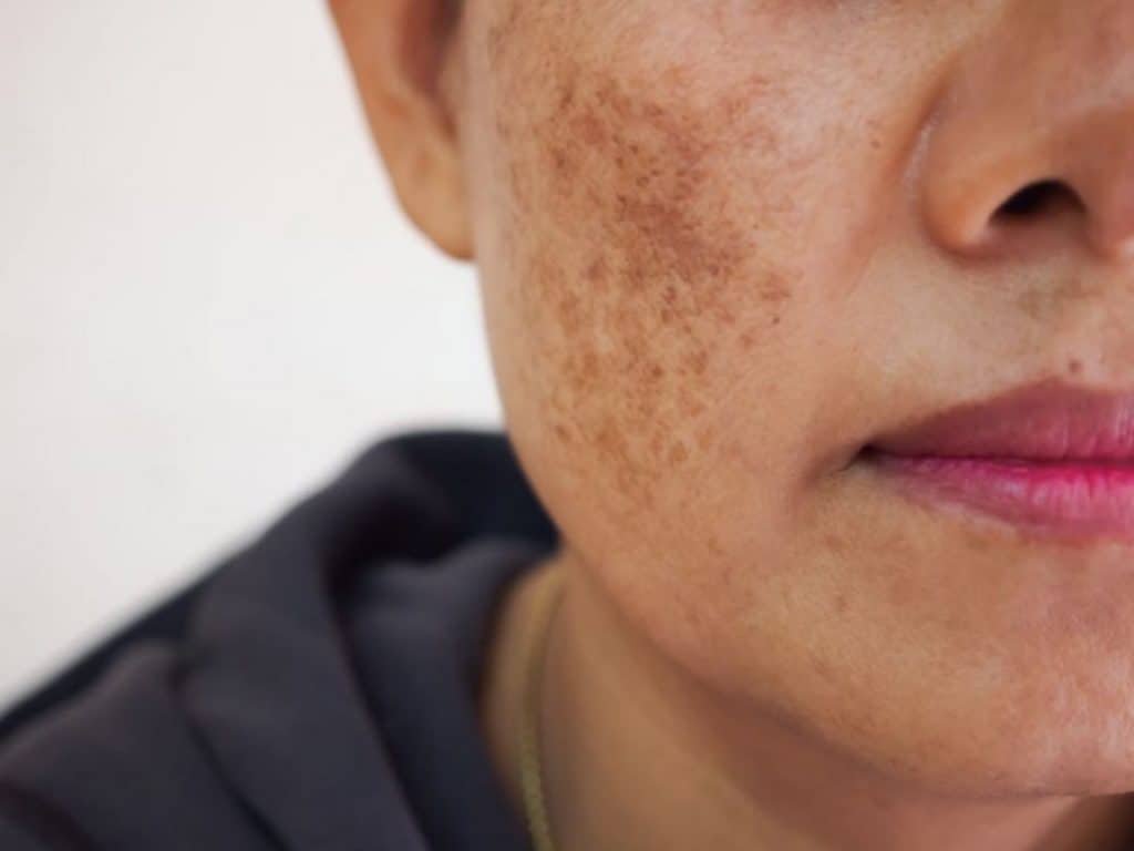 laser treatment for pigmentation