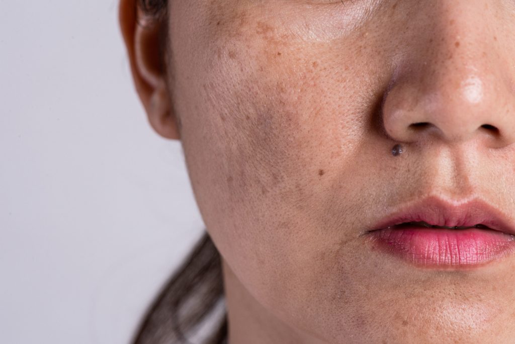 skin whitening treatment in malaysia
