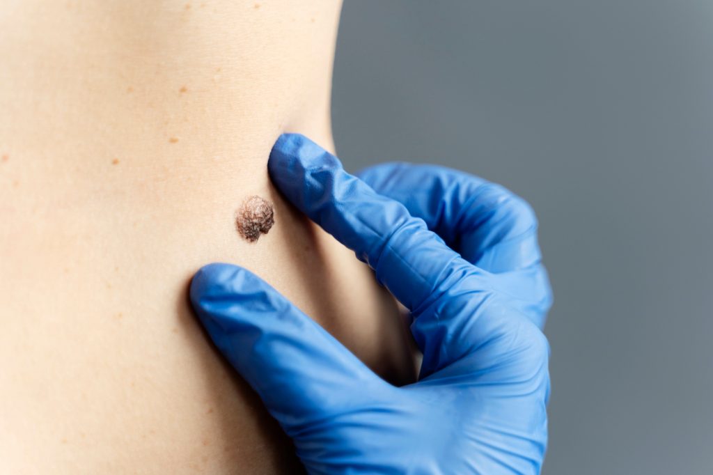 tattoo removal malaysia