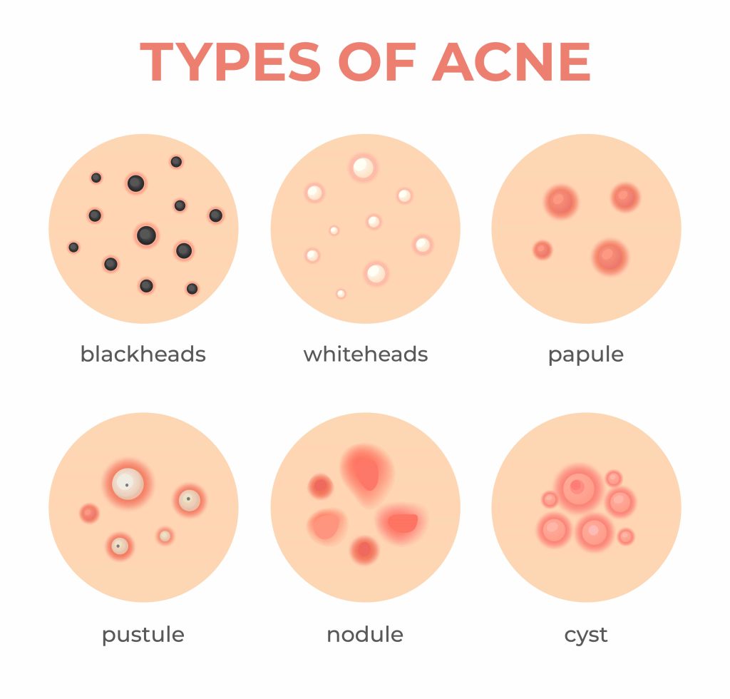 acne treatment specialist
