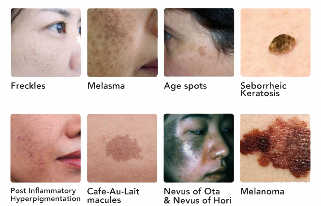 laser treatment for pigmentation