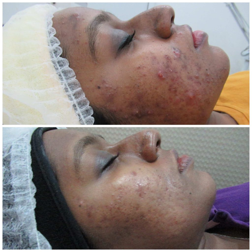 acne treatment specialist
