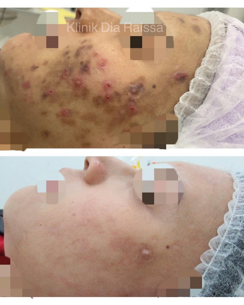 acne scar removal treatment malaysia