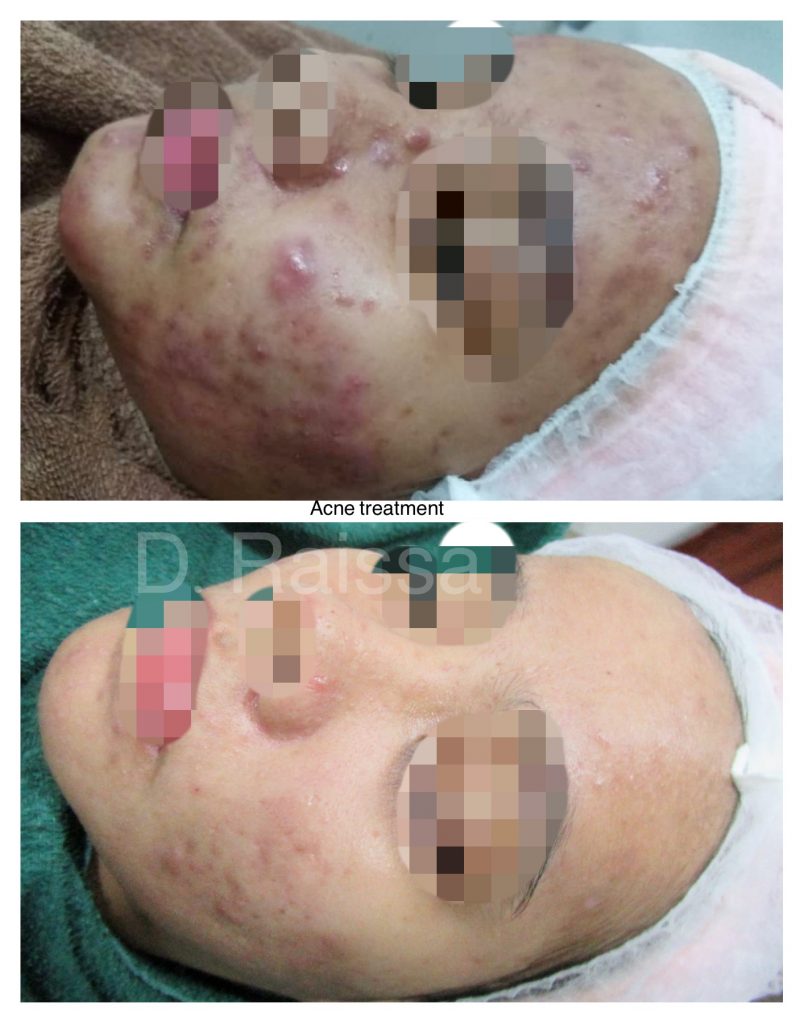 acne scar removal treatment malaysia