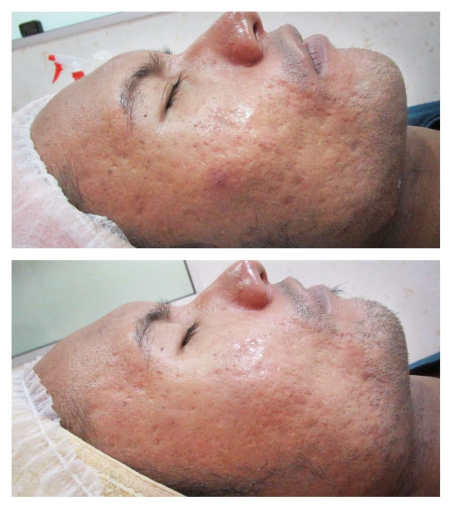acne treatment specialist
