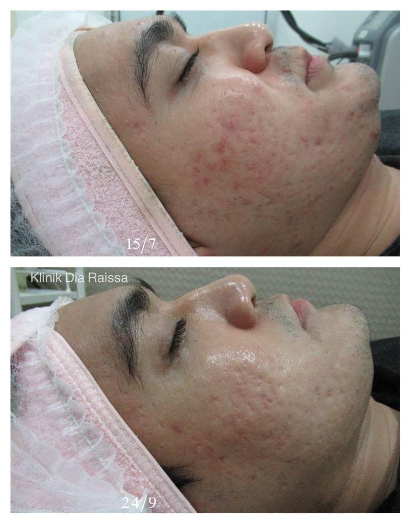 acne treatment specialist
