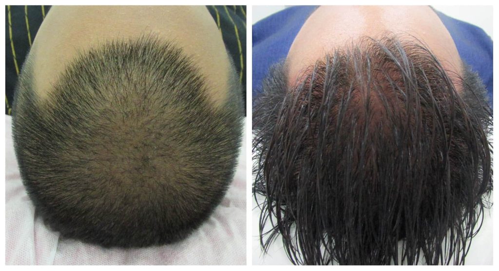 hair loss treatment malaysia
