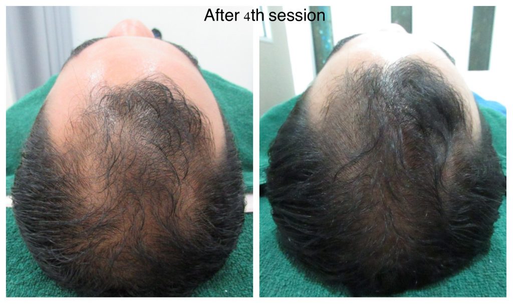 hair loss treatment malaysia
