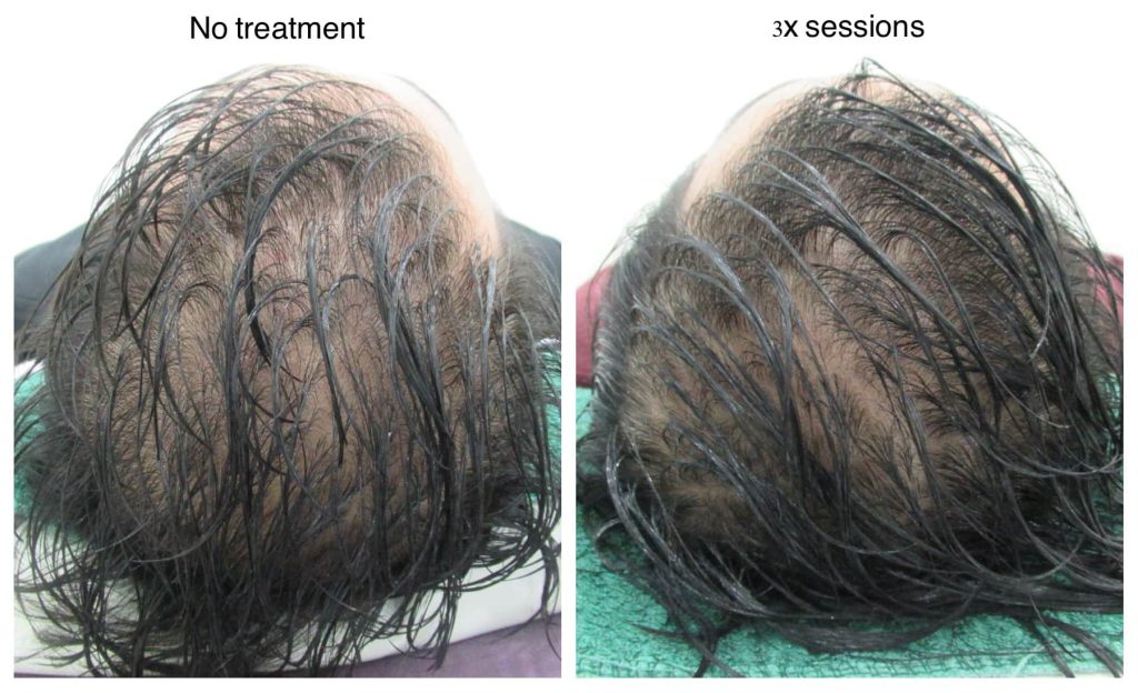 hair loss treatment malaysia