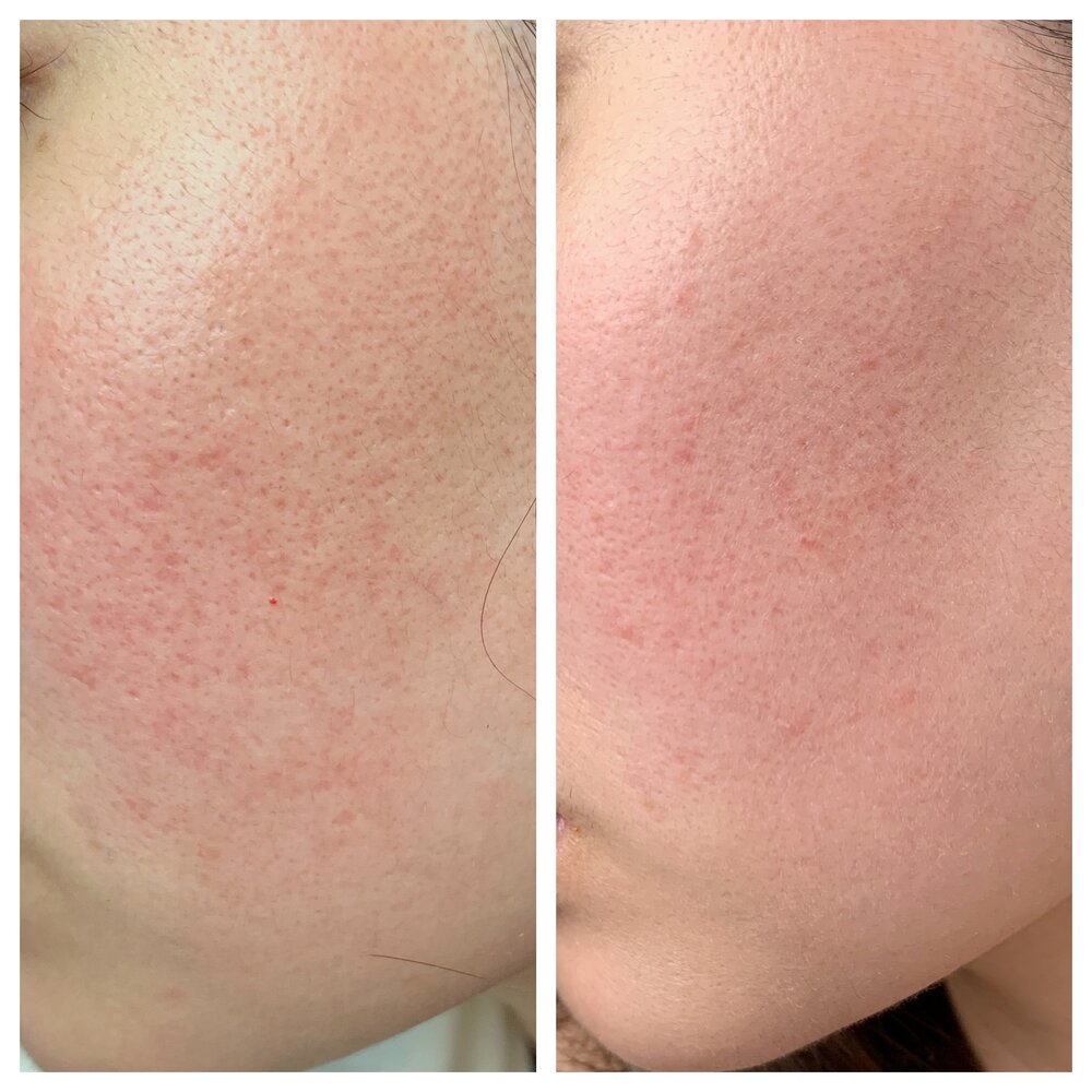 skin rejuvenation malaysia