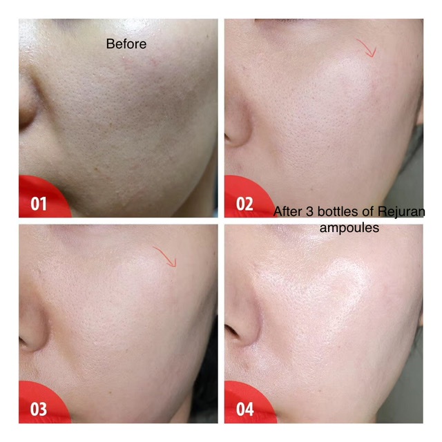 skin rejuvenation malaysia